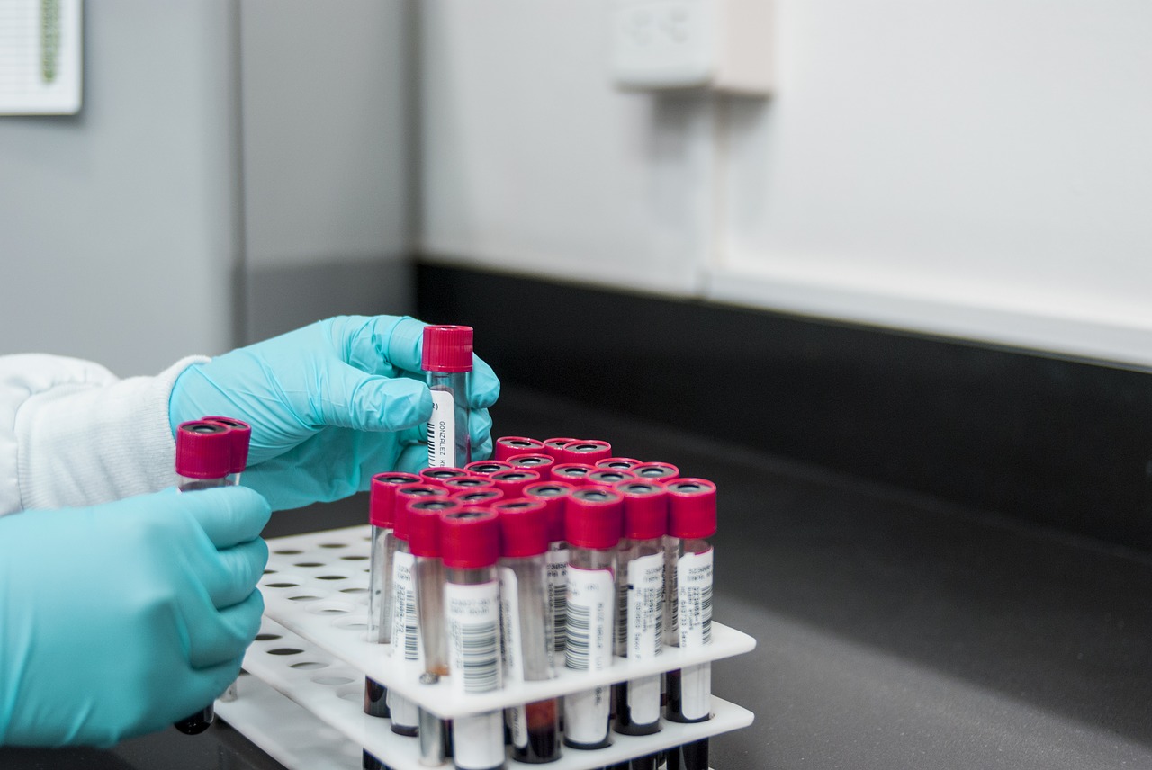 Covid-19 : le test rapide basé sur les anticorps ne serait pas suffisamment précis