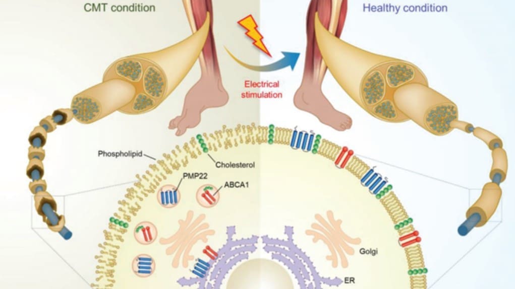 Maladie de charcot – marie -tooth : des scientifiques coréens ont